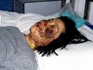 高蓉蓉2004年5月7日被酷刑折磨，脸上是电烧灼伤。照片是受伤10天后拍摄的。
